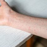 Hidalgo suma 18 casos de sarampión